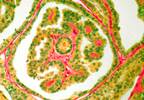 Structural Disease Risk Stratification in Pediatric Patients With Thyroid Cancer Structural Disease Risk Stratification in Pediatric Patients With Thyroid Cancer