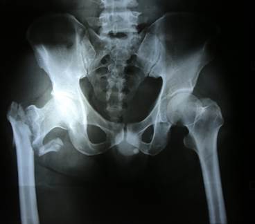 Updated Recommendation on Vit D and Calcium for Reducing Fx Risk Updated Recommendation on Vit D and Calcium for Reducing Fx Risk