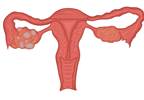 Predicting Metabolic Dysfunction in PCOS Through Acne, Hirsutism Predicting Metabolic Dysfunction in PCOS Through Acne, Hirsutism