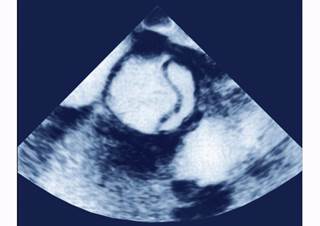 Ciprofloxacin should be used with caution in patients with aortic dilatation, researchers concluded. Ciprofloxacin should be used with caution in patients with aortic dilatation, researchers concluded.