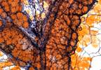 Thymidine Analogues, Didanosine Associated With Cardiovascular Risk Thymidine Analogues, Didanosine Associated With Cardiovascular Risk