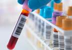 High, Low Values of CKD-MBD Markers Linked With Mortality High, Low Values of CKD-MBD Markers Linked With Mortality
