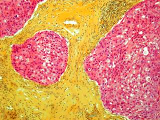 Women who received insulin glargine, compared with neutral protamine Hagedorn insulin, had a higher incidence of breast cancer. Women who received insulin glargine, compared with neutral protamine Hagedorn insulin, had a higher incidence of breast cancer.