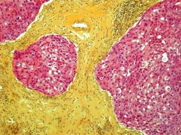 USPSTF Recommends Risk-Reducing Meds for Breast Cancer USPSTF Recommends Risk-Reducing Meds for Breast Cancer