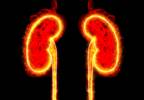 High Uric Acid Ups Renal Failure Risk in Some CKD Patients High Uric Acid Ups Renal Failure Risk in Some CKD Patients