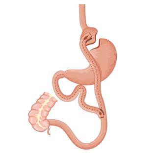 Safety of bariatric surgery is similar to that of commonly performed laparoscopic procedures, such as cholecystectomy or appendectomy. Safety of bariatric surgery is similar to that of commonly performed laparoscopic procedures, such as cholecystectomy or appendectomy.