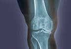 Higher Prevalence of Sarcopenic Obesity in Osteoarthritis Than Rheumatoid Arthritis Higher Prevalence of Sarcopenic Obesity in Osteoarthritis Than Rheumatoid Arthritis