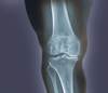 Higher Prevalence of Sarcopenic Obesity in Osteoarthritis Than Rheumatoid Arthritis Higher Prevalence of Sarcopenic Obesity in Osteoarthritis Than Rheumatoid Arthritis