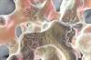 Prevention of Bone Loss in Patients With Epilepsy Prevention of Bone Loss in Patients With Epilepsy