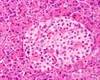 Childhood Antibiotic Use Not Linked to Islet or Celiac Disease Autoimmunity Childhood Antibiotic Use Not Linked to Islet or Celiac Disease Autoimmunity