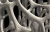 Prevention of Bone Mineral Density Loss Needed in Epilepsy Prevention of Bone Mineral Density Loss Needed in Epilepsy