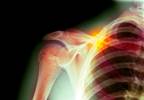 Alogliptin Associated With Lower Fracture Risk Than Linagliptin, Saxagliptin in T2D Alogliptin Associated With Lower Fracture Risk Than Linagliptin, Saxagliptin in T2D