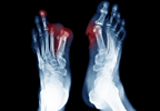 FDA Approves First Shock Wave Device for Treating Diabetic Foot Ulcers FDA Approves First Shock Wave Device for Treating Diabetic Foot Ulcers