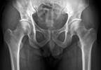 Romosozumab Followed by Alendronate Decreases Fracture Risk in Women With Osteoporosis Romosozumab Followed by Alendronate Decreases Fracture Risk in Women With Osteoporosis
