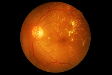 FDA Approves AI Device to Detect Diabetic Retinopathy FDA Approves AI Device to Detect Diabetic Retinopathy