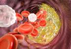 Adding Ezetimibe to Statin Therapy: Cardiovascular Outcomes in Diabetes Adding Ezetimibe to Statin Therapy: Cardiovascular Outcomes in Diabetes