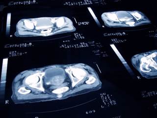 The researchers found that there were more obese patients in the high- vs low-/intermediate-risk group. The researchers found that there were more obese patients in the high- vs low-/intermediate-risk group.