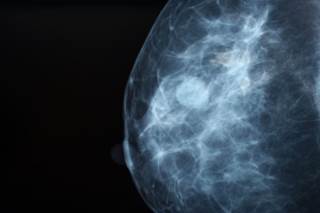 Among women with a longer duration of diabetes or preexisting cardiovascular disease, there was increased all-cause and cancer-specific mortality. Among women with a longer duration of diabetes or preexisting cardiovascular disease, there was increased all-cause and cancer-specific mortality.
