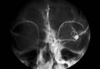 Lower Bone Mineral Density May Increase Intracranial Aneurysm Risk Lower Bone Mineral Density May Increase Intracranial Aneurysm Risk
