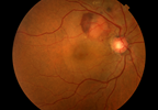 Proliferative Diabetic Retinopathy Independently Associated With CVD in T1D Proliferative Diabetic Retinopathy Independently Associated With CVD in T1D