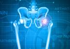 Denosumab May Increase BMD in Women With Primary Hyperparathyroidism Denosumab May Increase BMD in Women With Primary Hyperparathyroidism