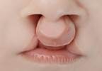 Risk for Congenital Malformations With Antithyroid Drugs Risk for Congenital Malformations With Antithyroid Drugs