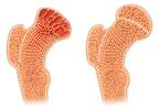 Damaging Effects of Gastric Bypass Surgery on Bone Mass and Microarchitecture Damaging Effects of Gastric Bypass Surgery on Bone Mass and Microarchitecture