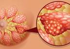 Higher Obesity-Related Cancer Risk in Women With Type 2 Diabetes Higher Obesity-Related Cancer Risk in Women With Type 2 Diabetes