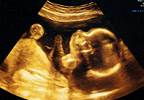 Children Exposed to Metformin In Utero Have Increased Risk of Being Overweight Children Exposed to Metformin In Utero Have Increased Risk of Being Overweight