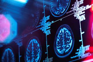 Researchers found that loss of vascular integrity was associated with greater 20-year decline. Researchers found that loss of vascular integrity was associated with greater 20-year decline.