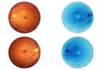 Repeated Ranibizumab Injections Does Not Impair Macular Perfusion Repeated Ranibizumab Injections Does Not Impair Macular Perfusion