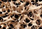 Greater Bone Formation With Teriparatide vs Zoledronic Acid in Osteoporosis Greater Bone Formation With Teriparatide vs Zoledronic Acid in Osteoporosis