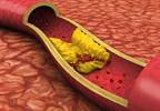 No Cardiovascular Benefit With Fenofibrate in T2D and Hypertriglyceridemia No Cardiovascular Benefit With Fenofibrate in T2D and Hypertriglyceridemia