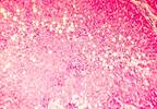 Red Meat Consumption Linked to Insulin Resistance and Steatohepatitis Red Meat Consumption Linked to Insulin Resistance and Steatohepatitis