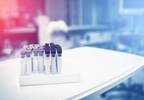 Low-Grade Inflammatory Markers May Help Differentiate Diabetes Diagnoses in Adults Low-Grade Inflammatory Markers May Help Differentiate Diabetes Diagnoses in Adults