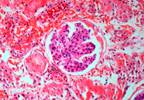 Chronic Kidney Disease May Be Common in Veterans Prior to Diabetes Diagnosis Chronic Kidney Disease May Be Common in Veterans Prior to Diabetes Diagnosis