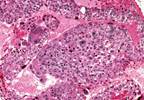 Diagnostic Value of Shear Wave Elastography for Parathyroid Adenomas Diagnostic Value of Shear Wave Elastography for Parathyroid Adenomas