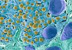 Islet Transplantation Improves Quality of Life in Type 1 Diabetes Islet Transplantation Improves Quality of Life in Type 1 Diabetes
