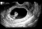 Risk for Congenital Anomaly With Exposure to Insulin Analogues in the First Trimester Risk for Congenital Anomaly With Exposure to Insulin Analogues in the First Trimester