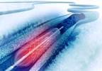 Improved Outcomes With CABG vs PCI for Diabetes With LV Dysfunction Improved Outcomes With CABG vs PCI for Diabetes With LV Dysfunction