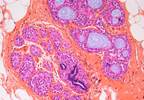 Overweight, Obesity Contributing to Cancers in Young Adults Overweight, Obesity Contributing to Cancers in Young Adults