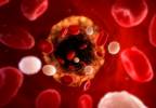 Menopause Symptom Severity May Predict Heart Disease Menopause Symptom Severity May Predict Heart Disease