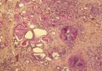 Nivolumab Associated With Thyroiditis in Patients With Cancer Nivolumab Associated With Thyroiditis in Patients With Cancer