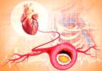 Increased Risk for Mortality in People With Diabetes, CHD Taking Beta-Blockers Increased Risk for Mortality in People With Diabetes, CHD Taking Beta-Blockers