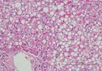 Factors Identified to Predict Fatty Liver in Obese Teens Factors Identified to Predict Fatty Liver in Obese Teens