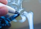 Hip Fracture Risk May Be Overestimated in Type 2 Diabetes Hip Fracture Risk May Be Overestimated in Type 2 Diabetes