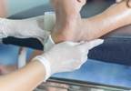 No Link Between HbA1c Levels and Wound Healing in Patients With Diabetic Foot Ulcers No Link Between HbA1c Levels and Wound Healing in Patients With Diabetic Foot Ulcers