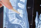 Anxiety Levels Tied to Bone Mineral Density in Postmenopausal Women Anxiety Levels Tied to Bone Mineral Density in Postmenopausal Women