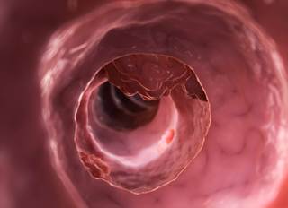 The risk for colorectal cancer decreased with increased duration of metformin use in men. The risk for colorectal cancer decreased with increased duration of metformin use in men.