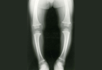 Burosumab May Benefit Children With X-Linked Hypophosphatemia Burosumab May Benefit Children With X-Linked Hypophosphatemia